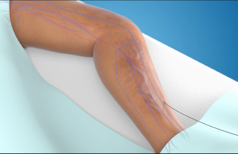 Image of a leg needing VenaSeal treatment relief from varicose vein issues