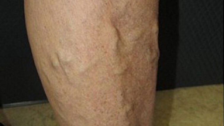 Varicose vein closeup