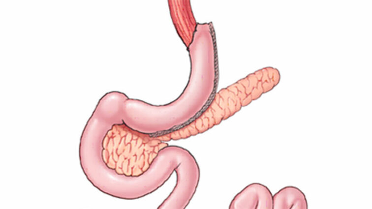 Gastric sleeve illustration close-up