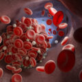 Illustration of blood clots floating in a vein