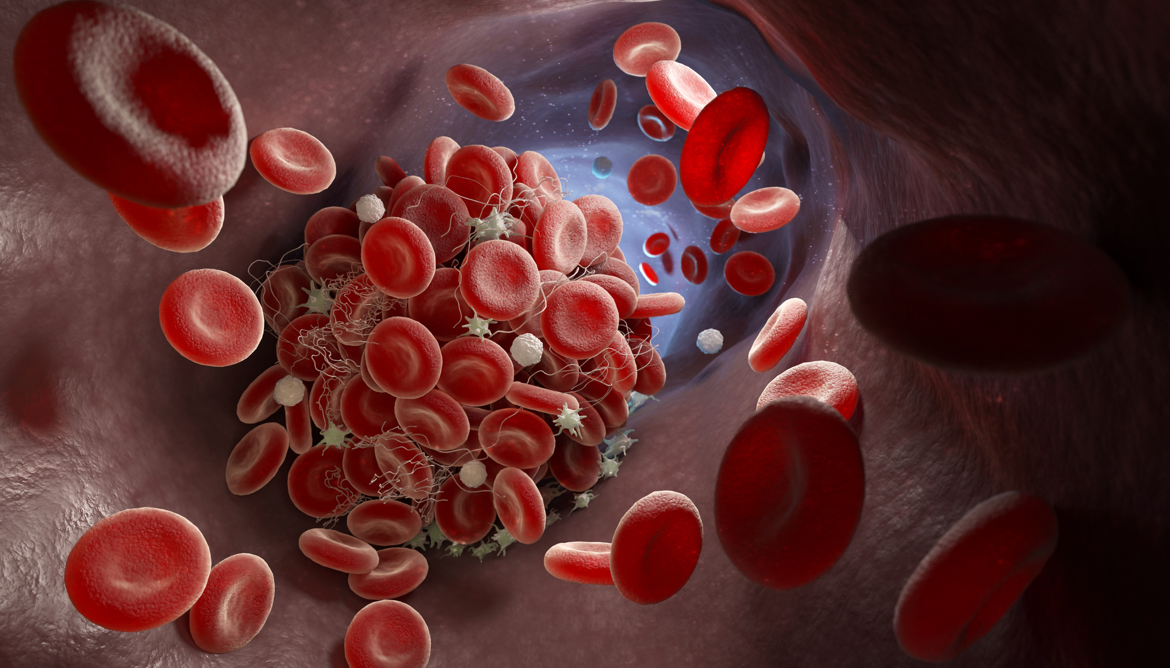 Illustration of blood clots floating in a vein