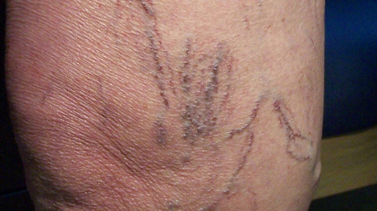Spider vein closeup