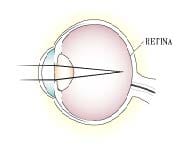 Nearsightedness-Myopia illustration
