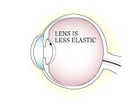 Presbyopia illustration