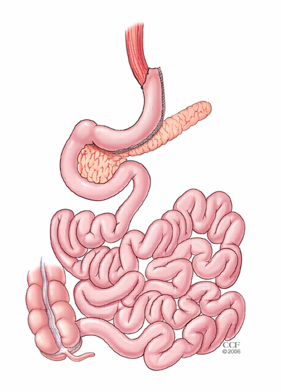 Gastric sleeve illustration
